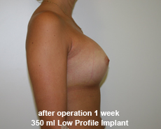 plastic-surgery-breast-augmentation